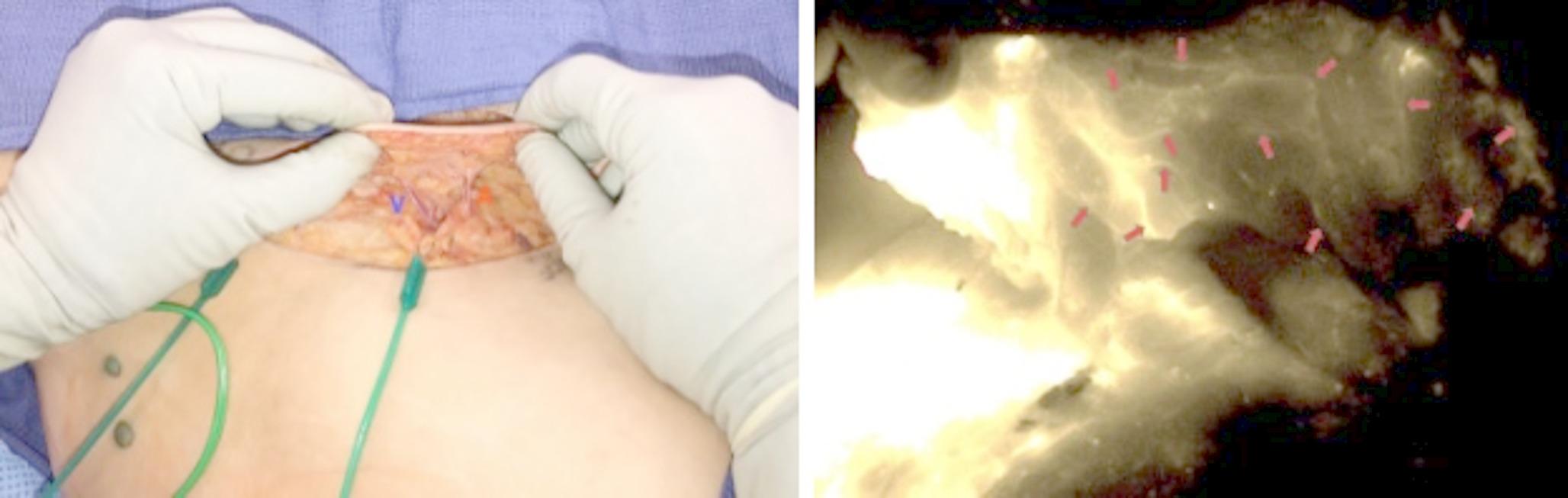 New Frontiers: Innovative Surgical Techniques and Breakthroughs in the Management of Breast Cancer Related Lymphedema
