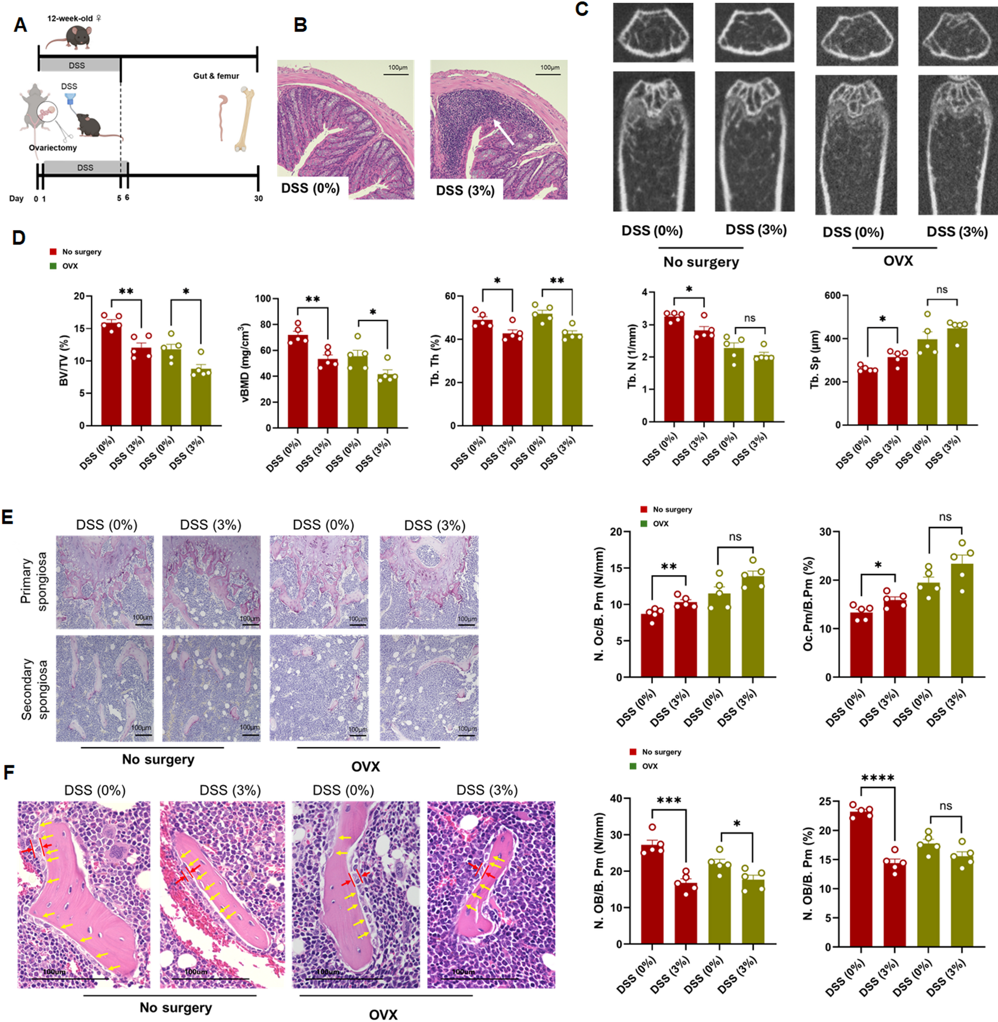 Transcriptomic profiling reveals a dramatic inflammatory shift in osteal macrophages during colitis-induced osteoporosis