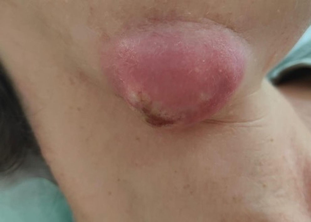 Complicated ulceroglandular tularemia