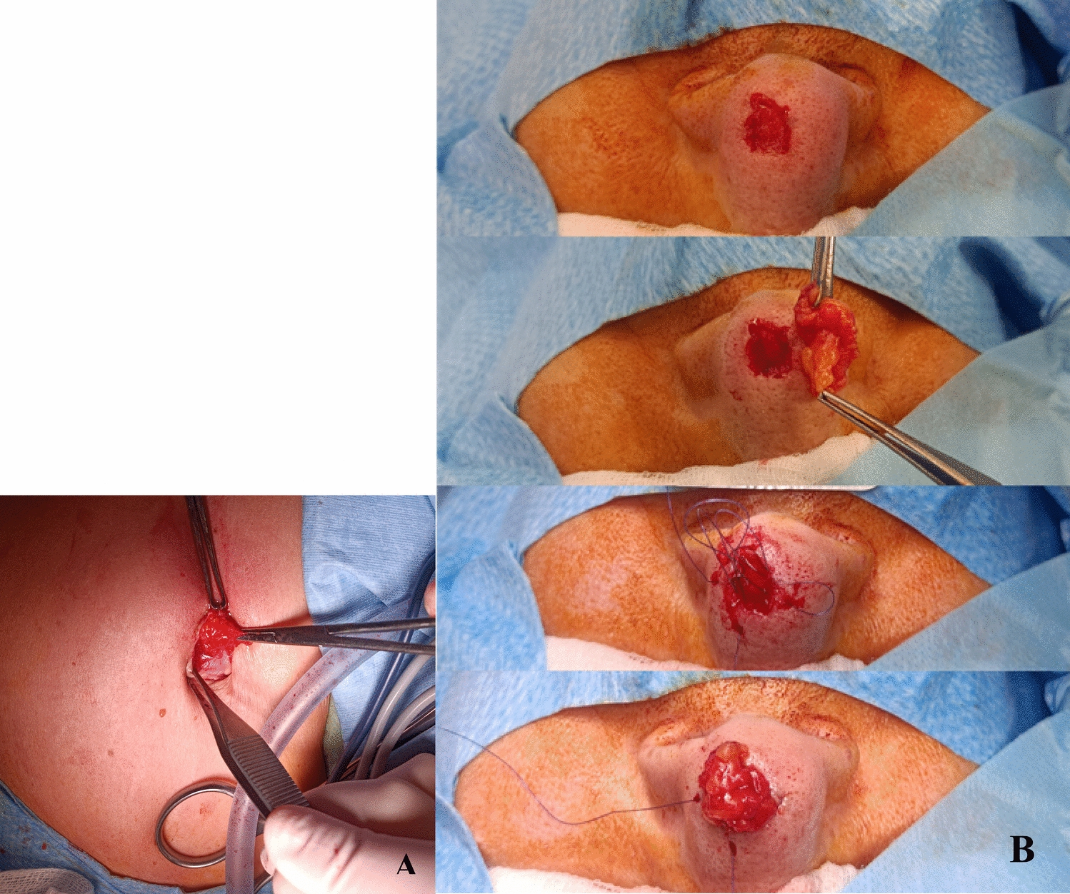 Fat Graft Transfer in Nasal Tip Reconstruction