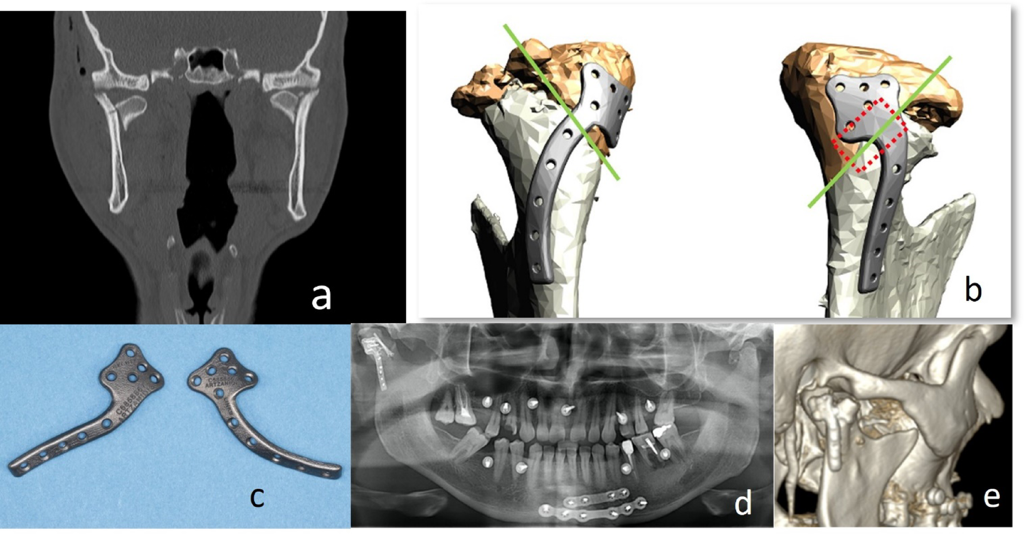 Patient-Specific Devices for Surgical Treatment of Mandibular Condylar Head Fractures: Case Series of Early Experiences and Pitfalls