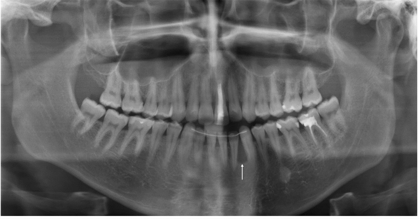 The Clear Cell Odontogenic Carcinoma: Case Report of a Rare Jaw Malignancy