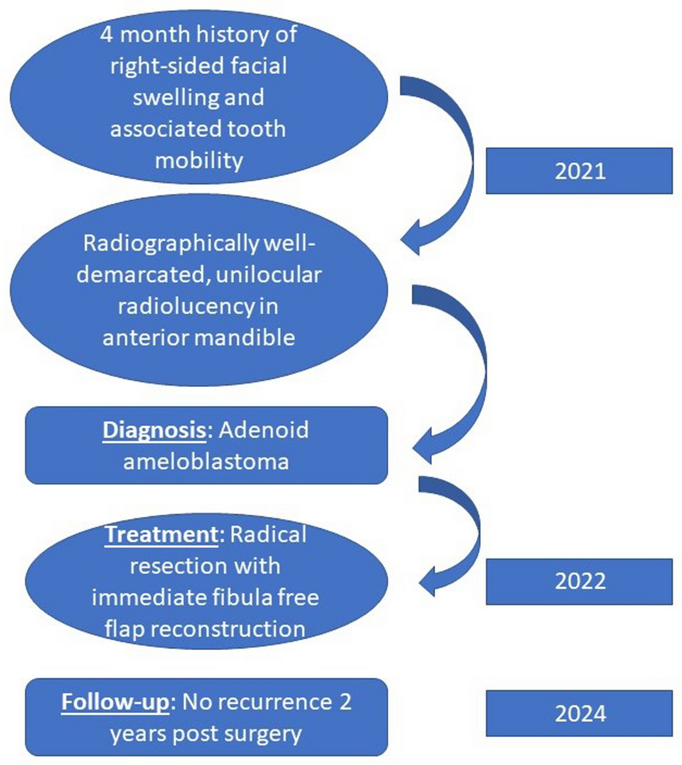 Adenoid Ameloblastoma: A Case Report on this Newly Recognized Under-Treated Odontogenic Tumour