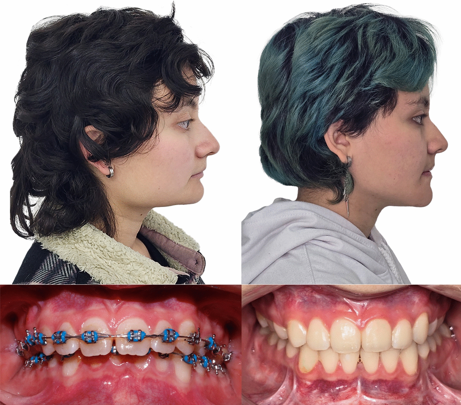 Short Face Correction with Orthognathic Surgery Using an Autologous Mandibular Angle Graft