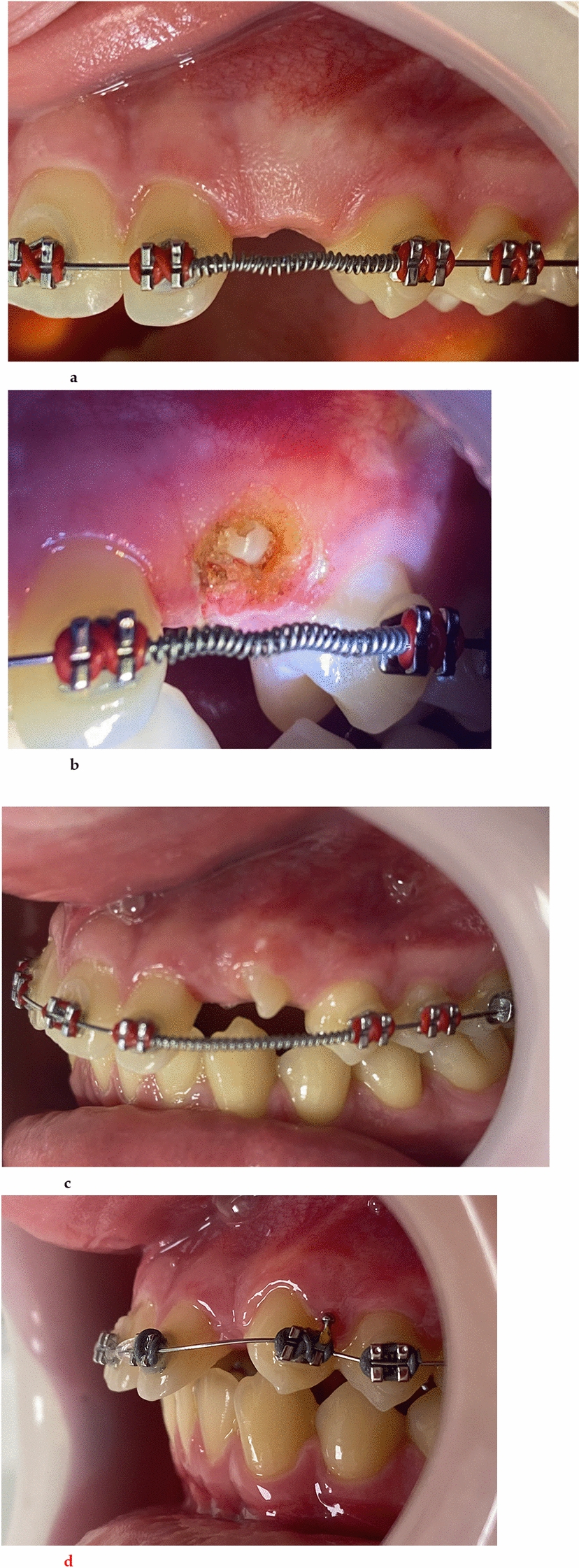 Diode Laser Applications for Muco-Gingival Surgical Orthodontics; A Case Series