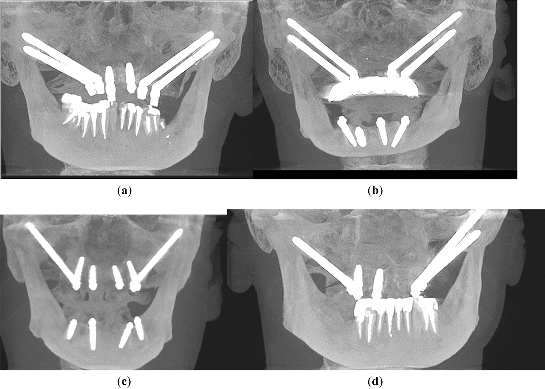 Evaluating Zygomatic Implants in Orbital Floor Complications: A Clinical and Anatomical Study