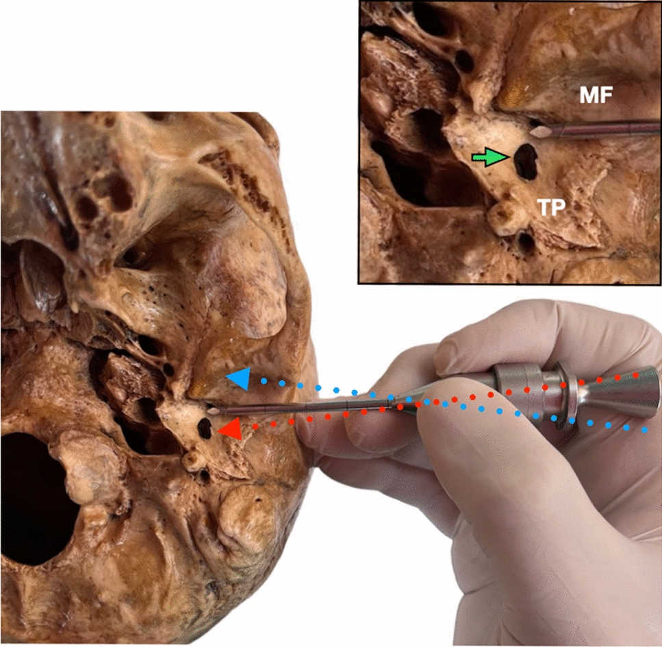 Prevalence of the Huschke Foramen in Colombian Population: An Important Anatomic Alteration for the Planning of TMJ Arthroscopy