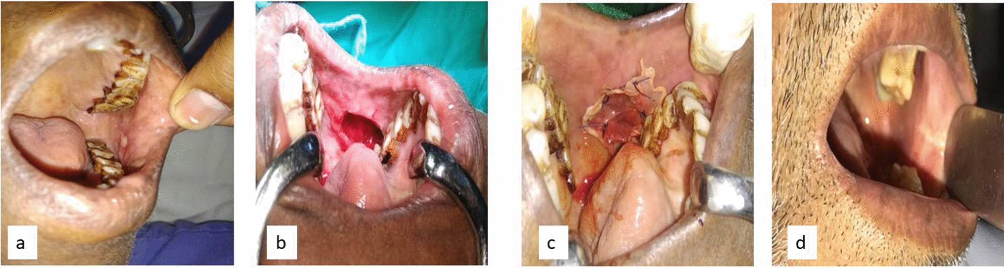 Recombinant Platelet-Derived Growth Factor-BB (rhPDGF-BB) Augmented Collagen Grafting for Oral Mucosal Defect Reconstruction