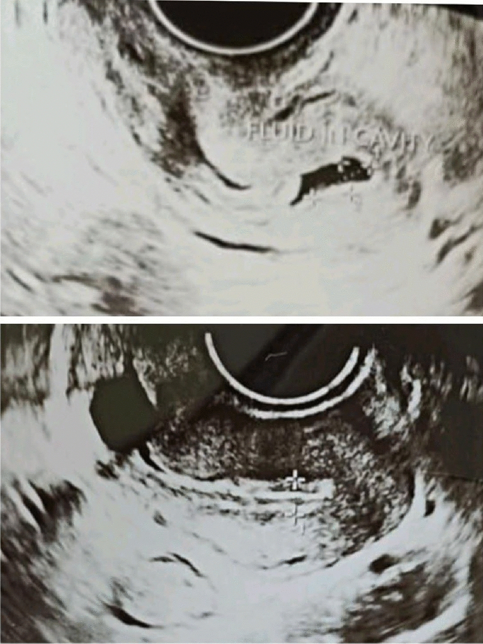 Successful Conception in a Turner Syndrome Mosaic Patient (45,X/46,XX) Following Oocyte Donation, Optimized Endometrial Preparation, and Adequate Luteal Phase Support: A Case Report