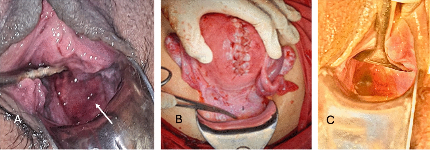 Small-Cell Neuroendocrine Carcinoma of the Cervix at 21 Weeks of Gestation: Multidisciplinary Management and Outcomes