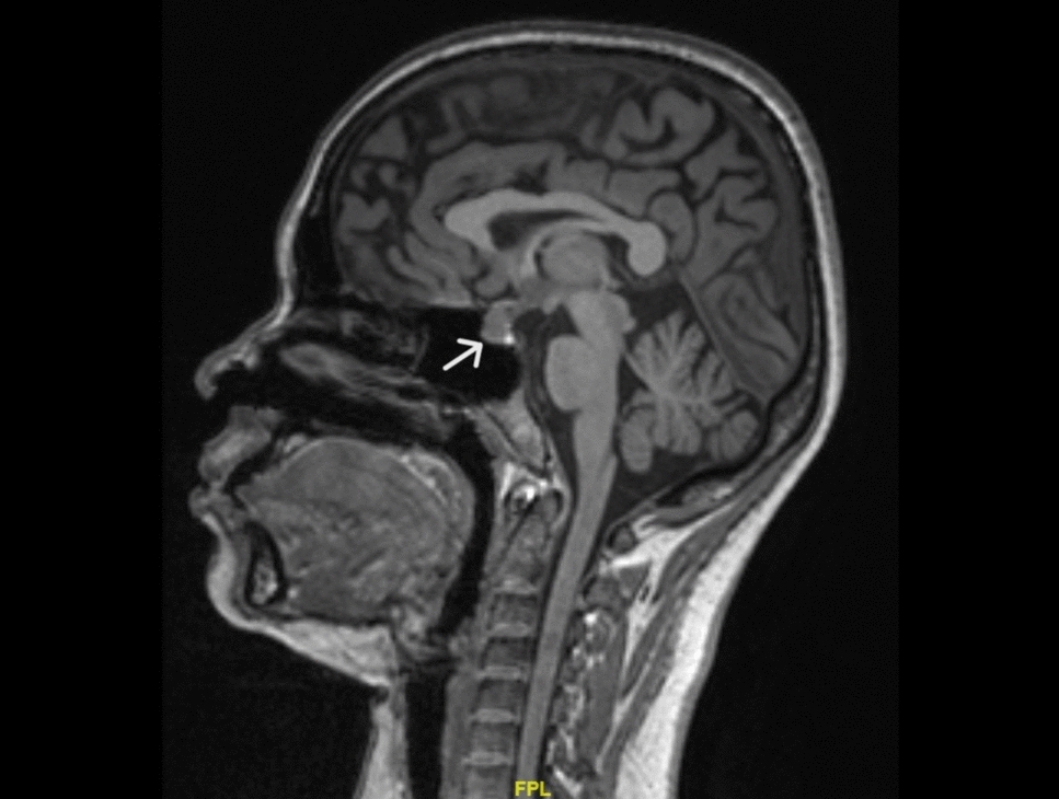 Prolactinoma Diagnosed During Pregnancy due to Quadrantanopia: A Rare Case Report