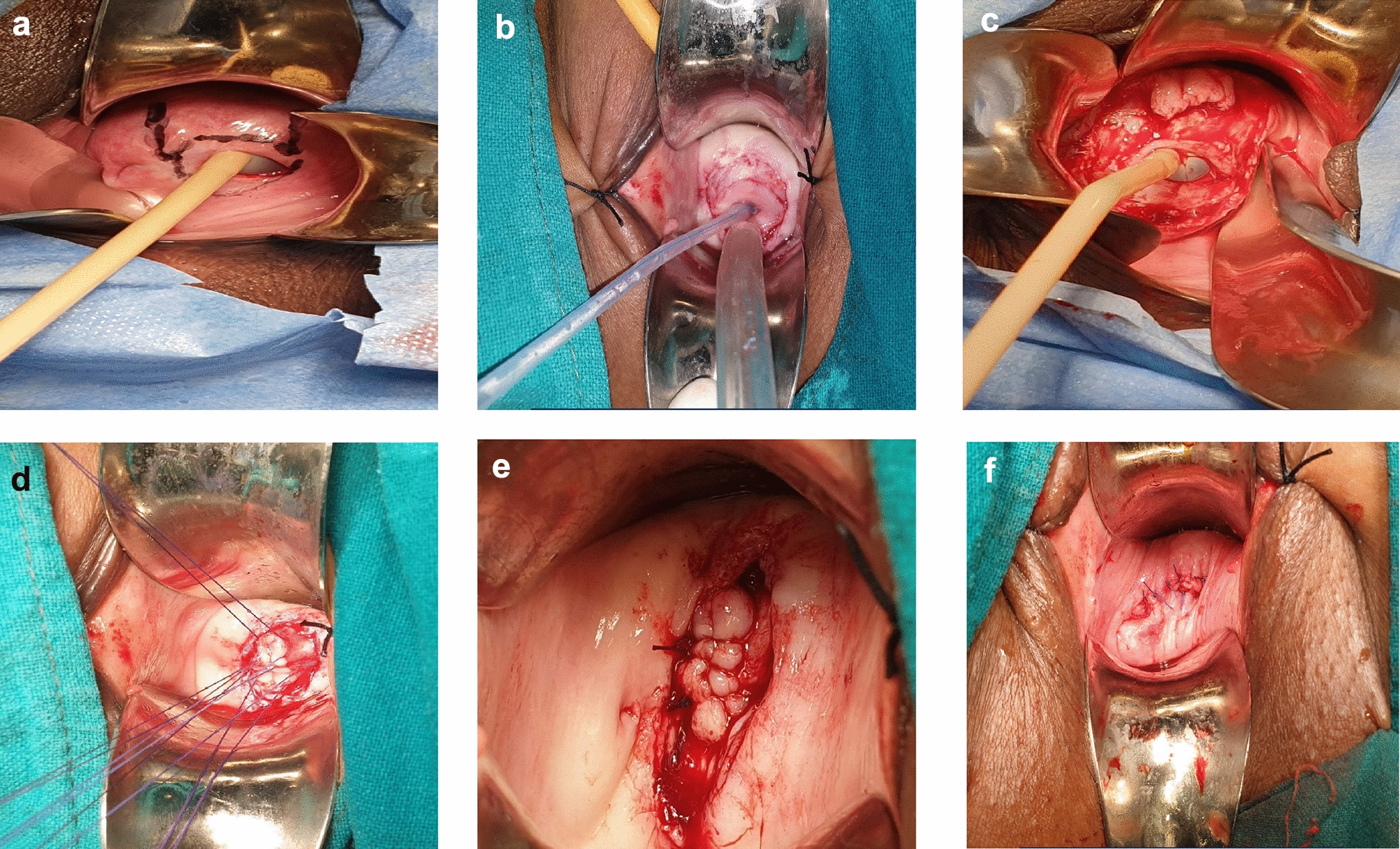 ‘‘Optimizing Vesicovaginal Fistula Management in Low-Resource Environments: The Role of the Transvaginal Approach’’