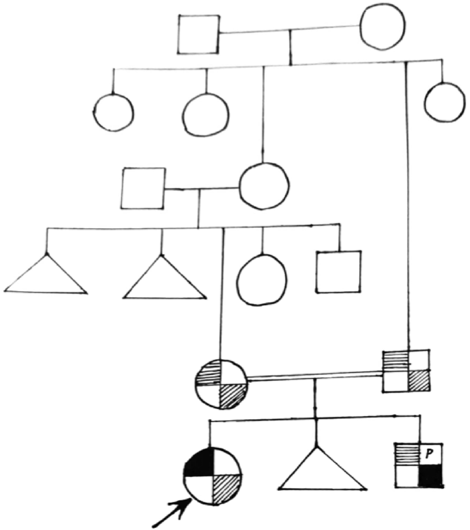 Prenatal Diagnosis of Charcot–Marie–Tooth Disease in a Foetus with Prenatal Carrier Status for Ethylmalonic Encephalopathy