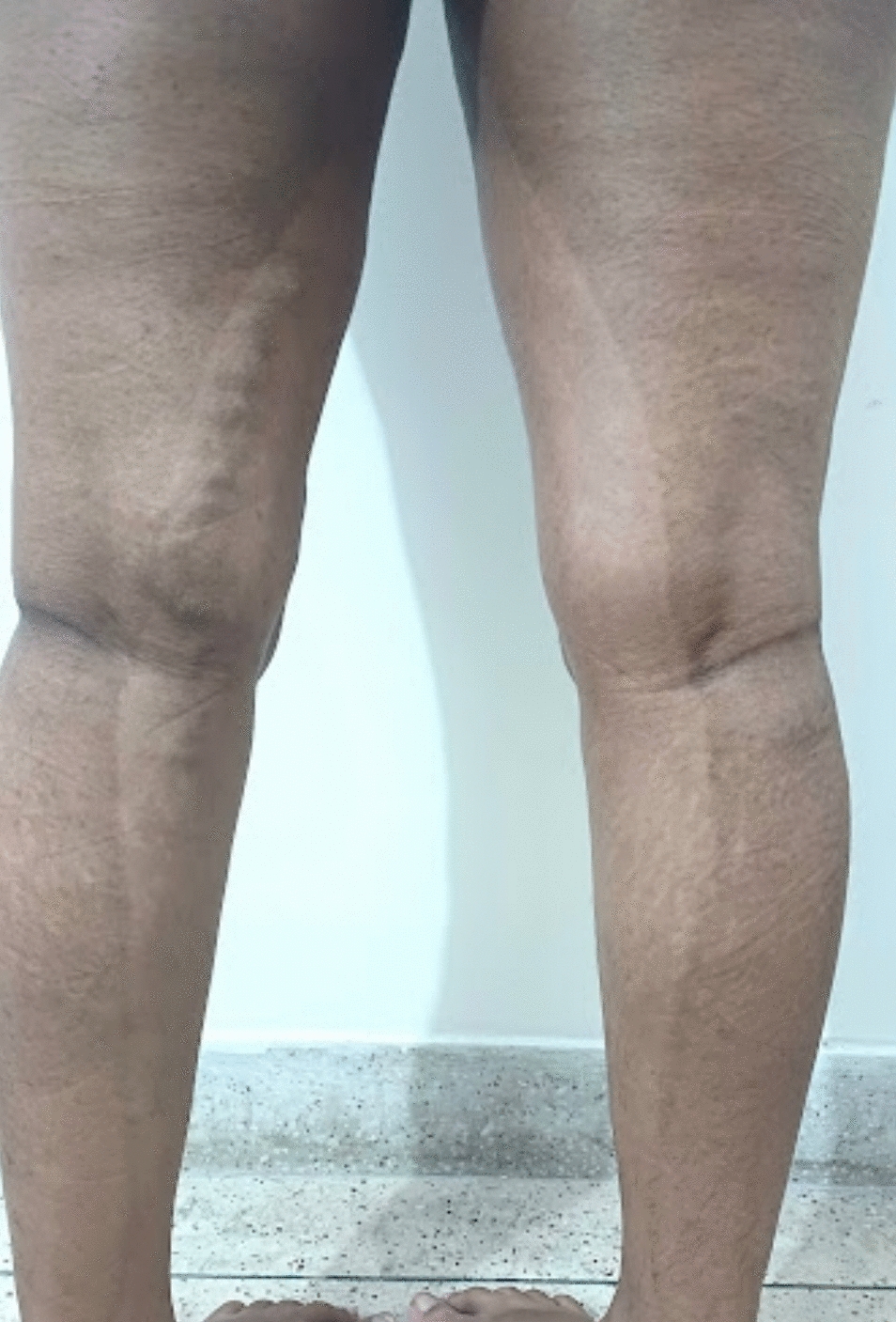 Pigmentary Demarcation Line-Rare Presentation During Pregnancy: Case Report