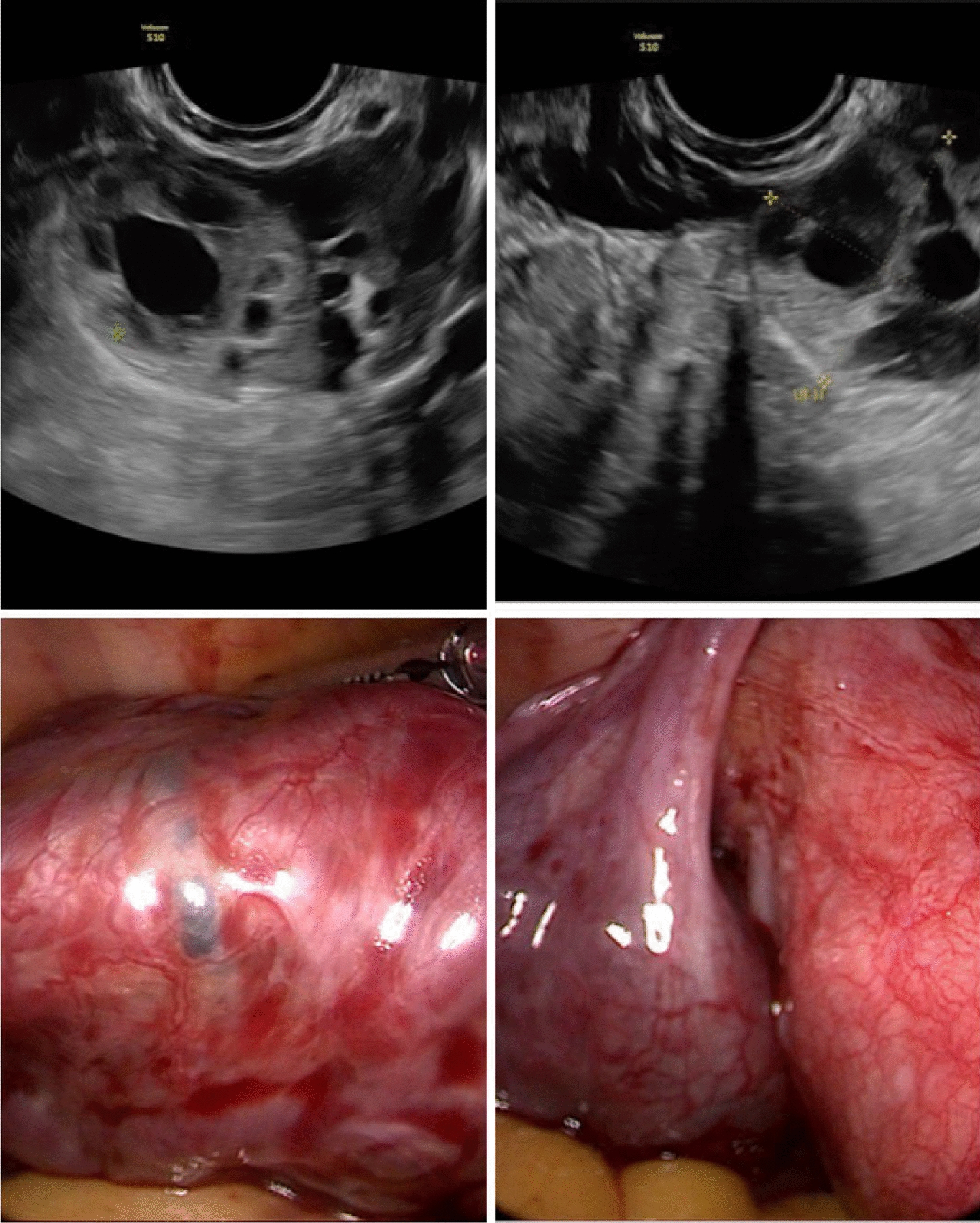 Ruptured Tubal Ectopic Pregnancy as Partial Hydatidiform Mole