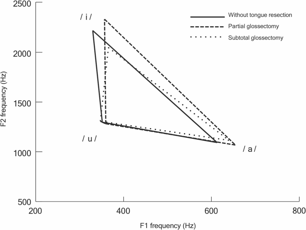 Acoustic analysis in the assessment of postoperative speech impairment in oral cancer patients