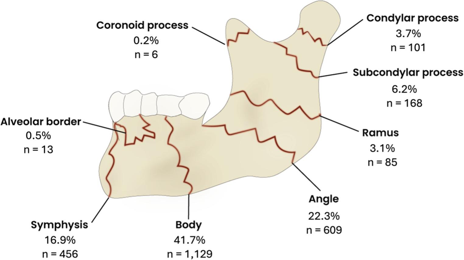 Early outcomes and risk factors in open reduction and internal fixation of mandibular fractures in adults: a 15-Year multi-institutional analysis of 2,705 cases
