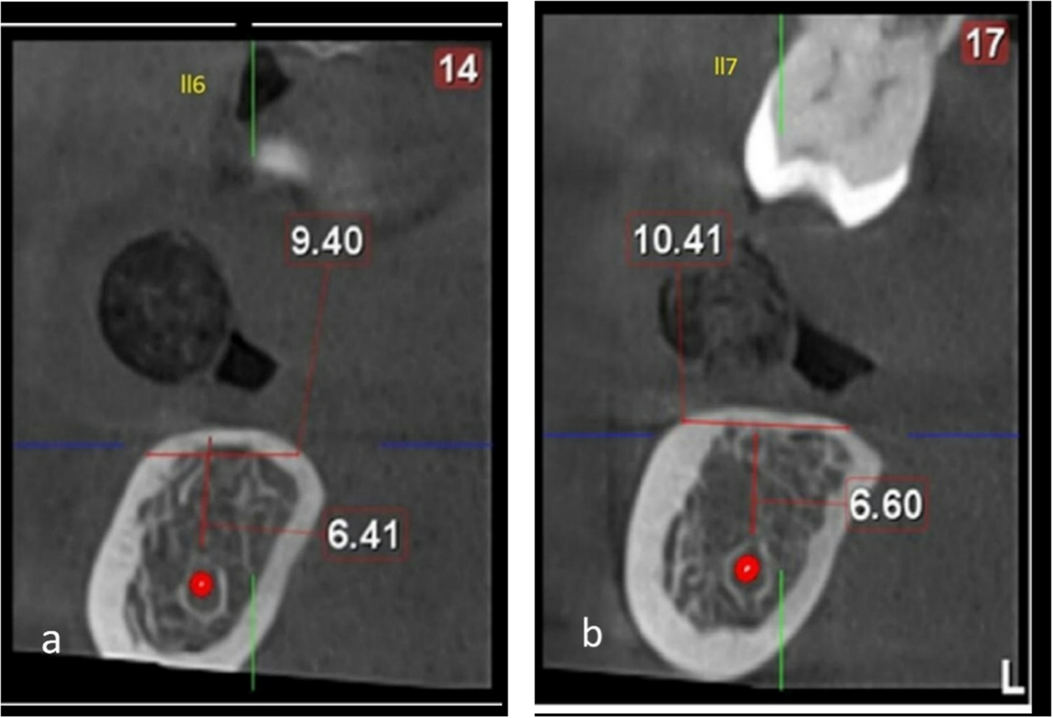 Evaluation of allogenic bone ring graft with simultaneous implant placement for vertical ridge augmentation