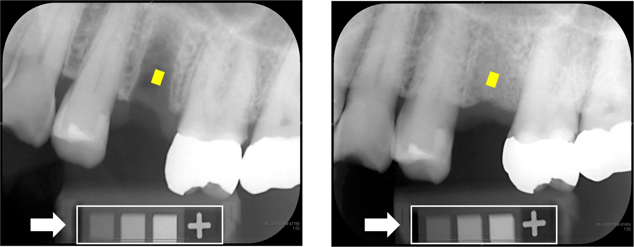 Association between bone turnover markers and alveolar socket healing rate: A cross-sectional study