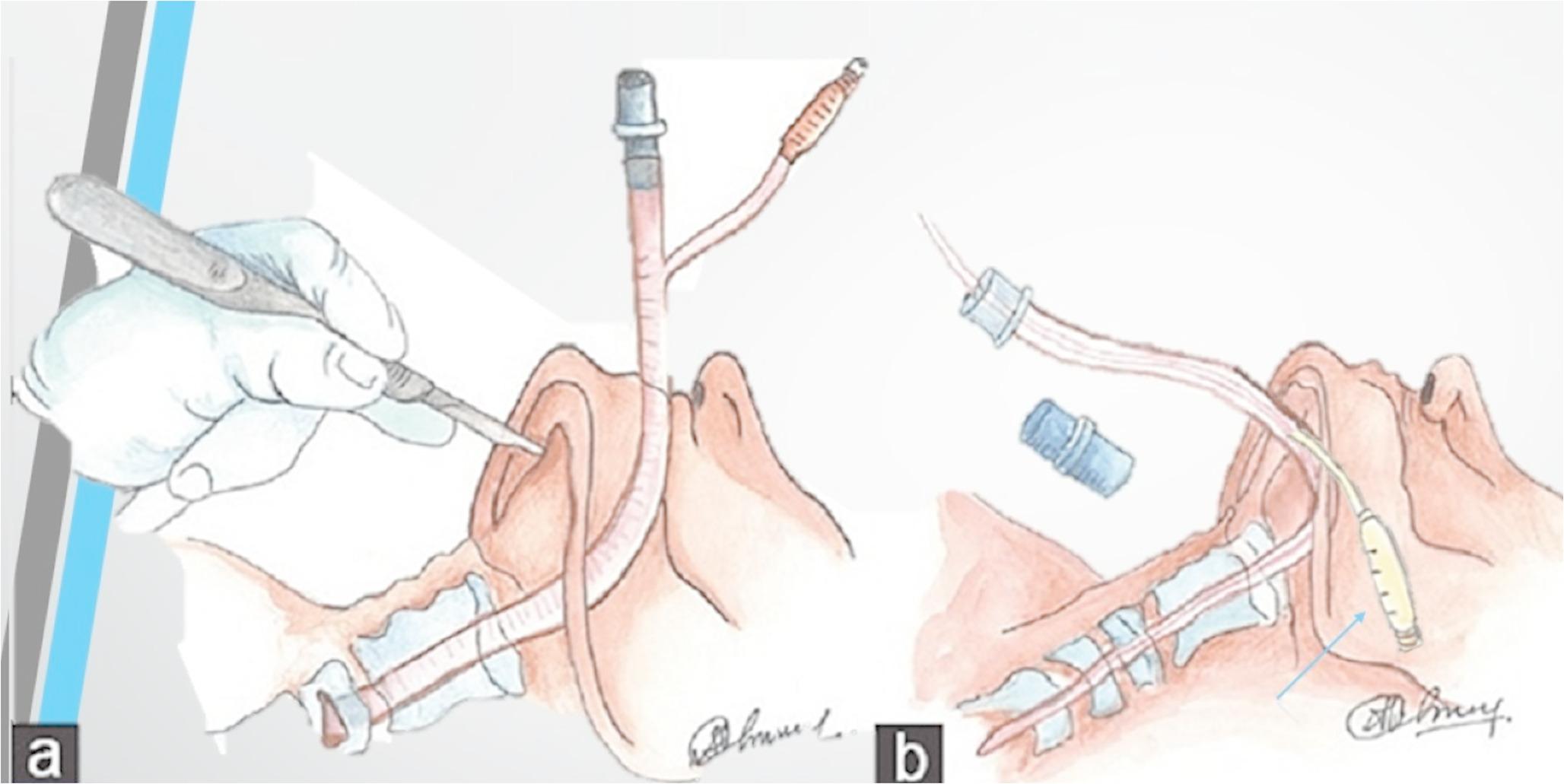 Evaluation of the safety and complications of submental intubation in maxillofacial trauma patients: a five-year clinical and ultrasonographic study (2018–2023)