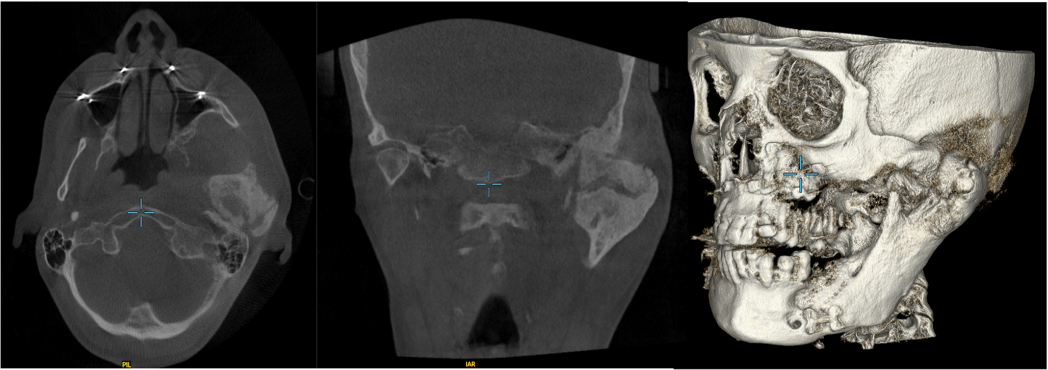 Temporomandibular joint ankylosis following bimaxillary surgery in a patient with neurofibromatosis type 1: a case report