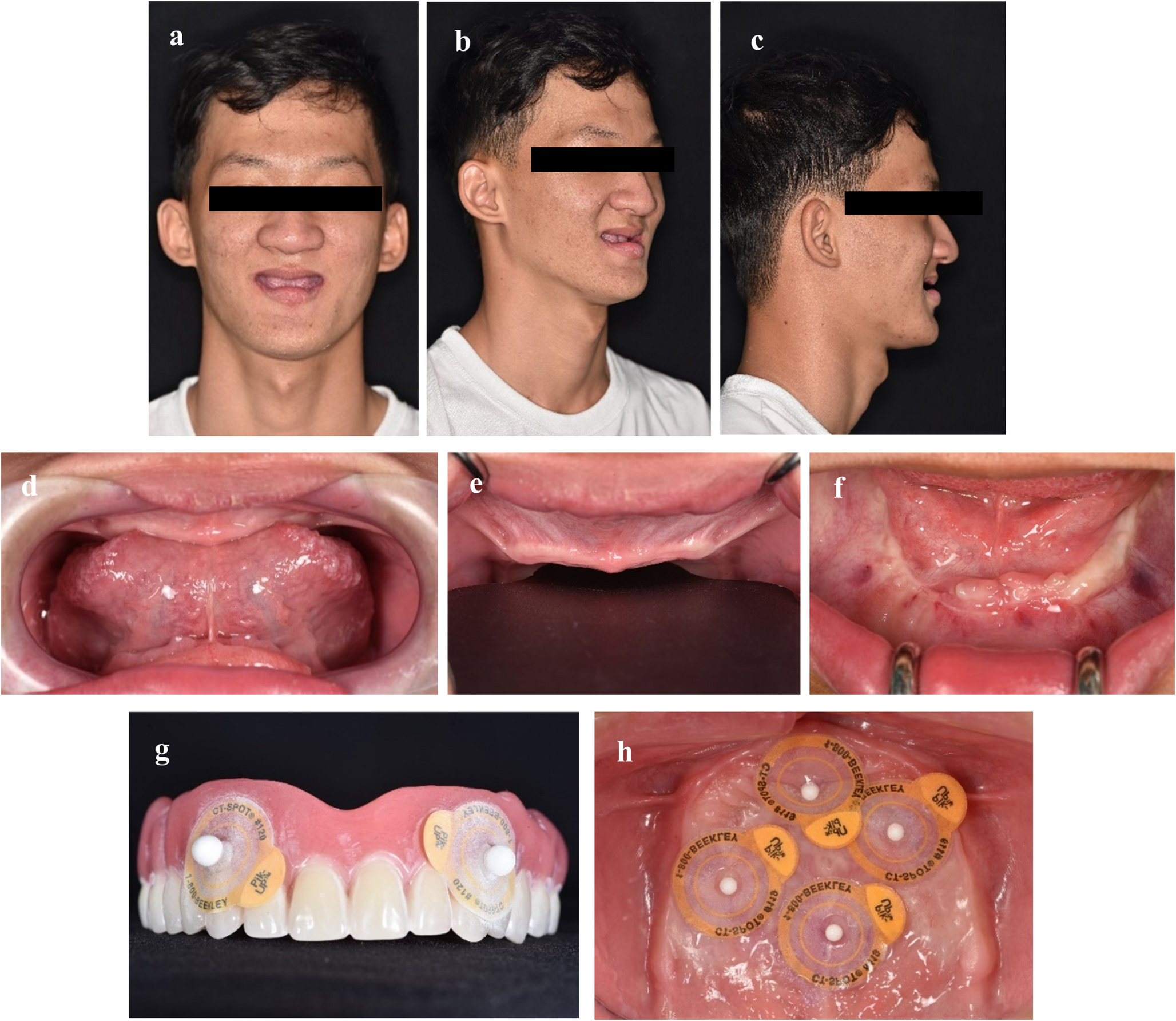 Customized implants and All-on-4 in the rehabilitation of anodontia: A case report