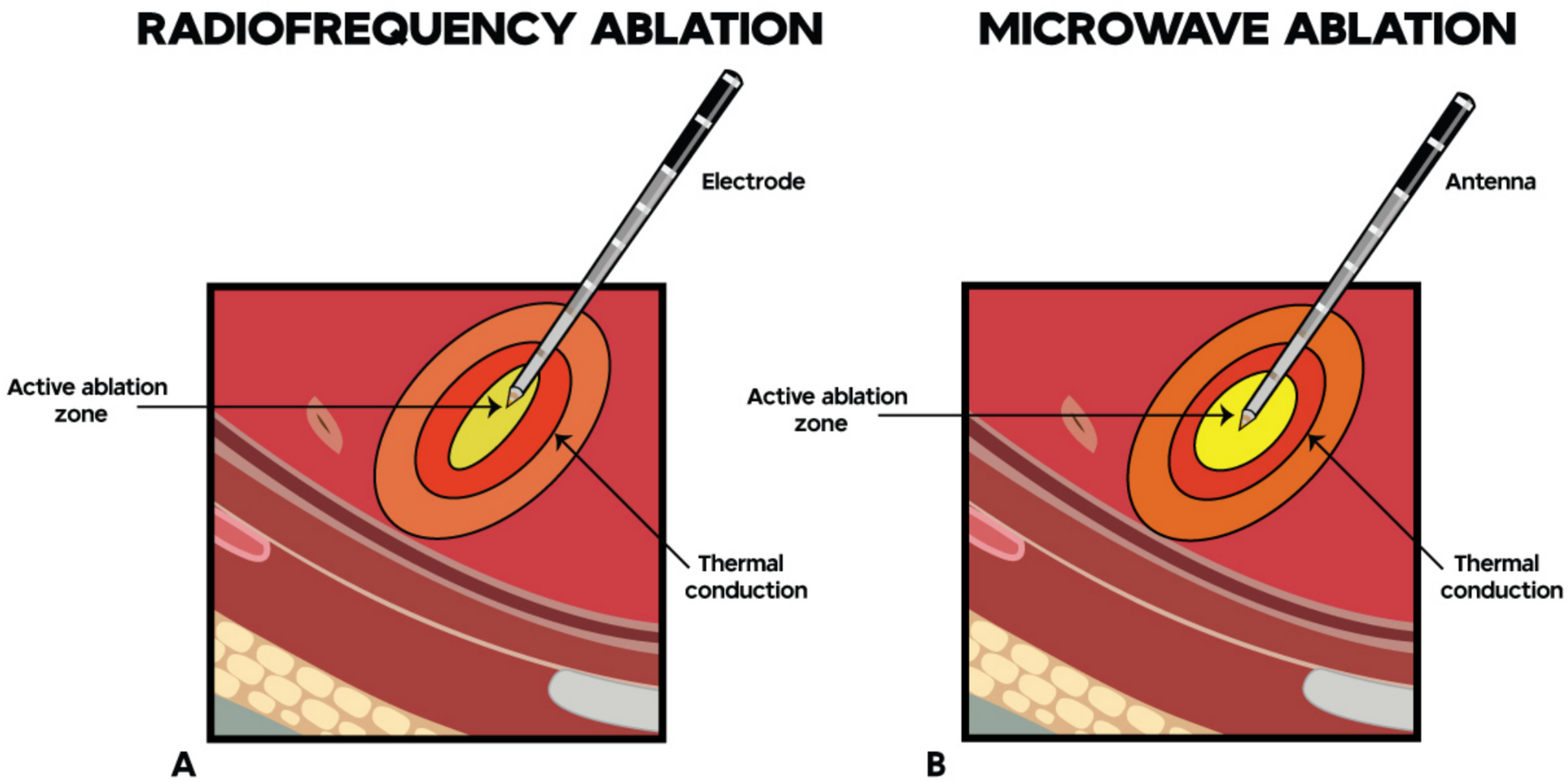Transbronchial Therapeutic Options for Malignant Peripheral Lesions- where we are now and where we are Going. Ablation/Drugs/Adjuvant Therapies
