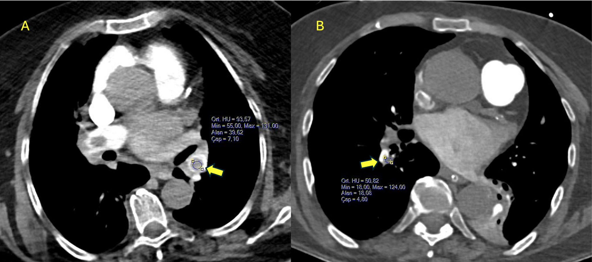 The prognostic role of pulmonary artery thrombus density among patients with intermediate-risk pulmonary embolism