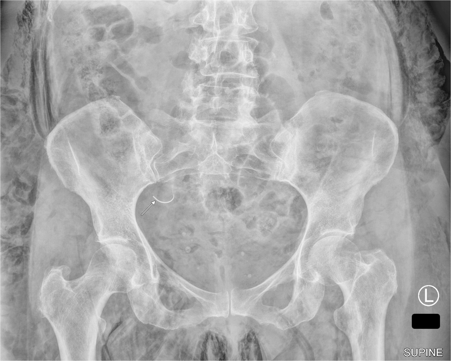 Diagnostic performance of radiology residents versus attending radiologists in detecting retained surgical items: a pilot study