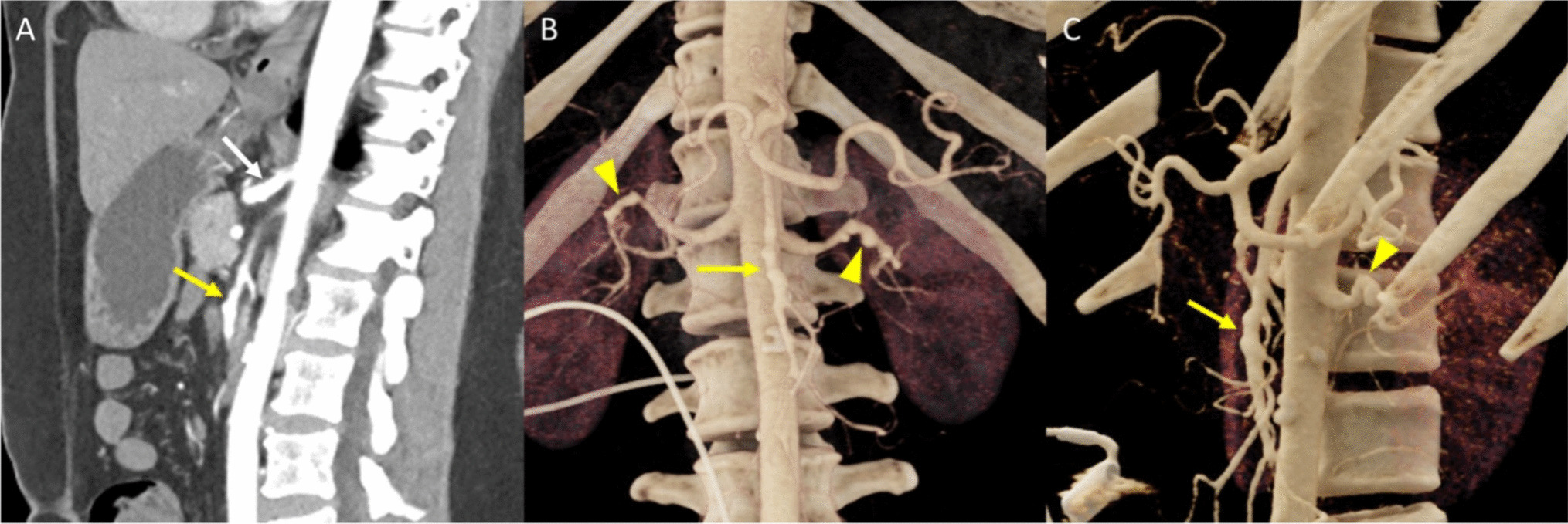 A visual guide for emergency radiologists navigating the complexity of abdominal vasculitis: part 2 – the mimickers