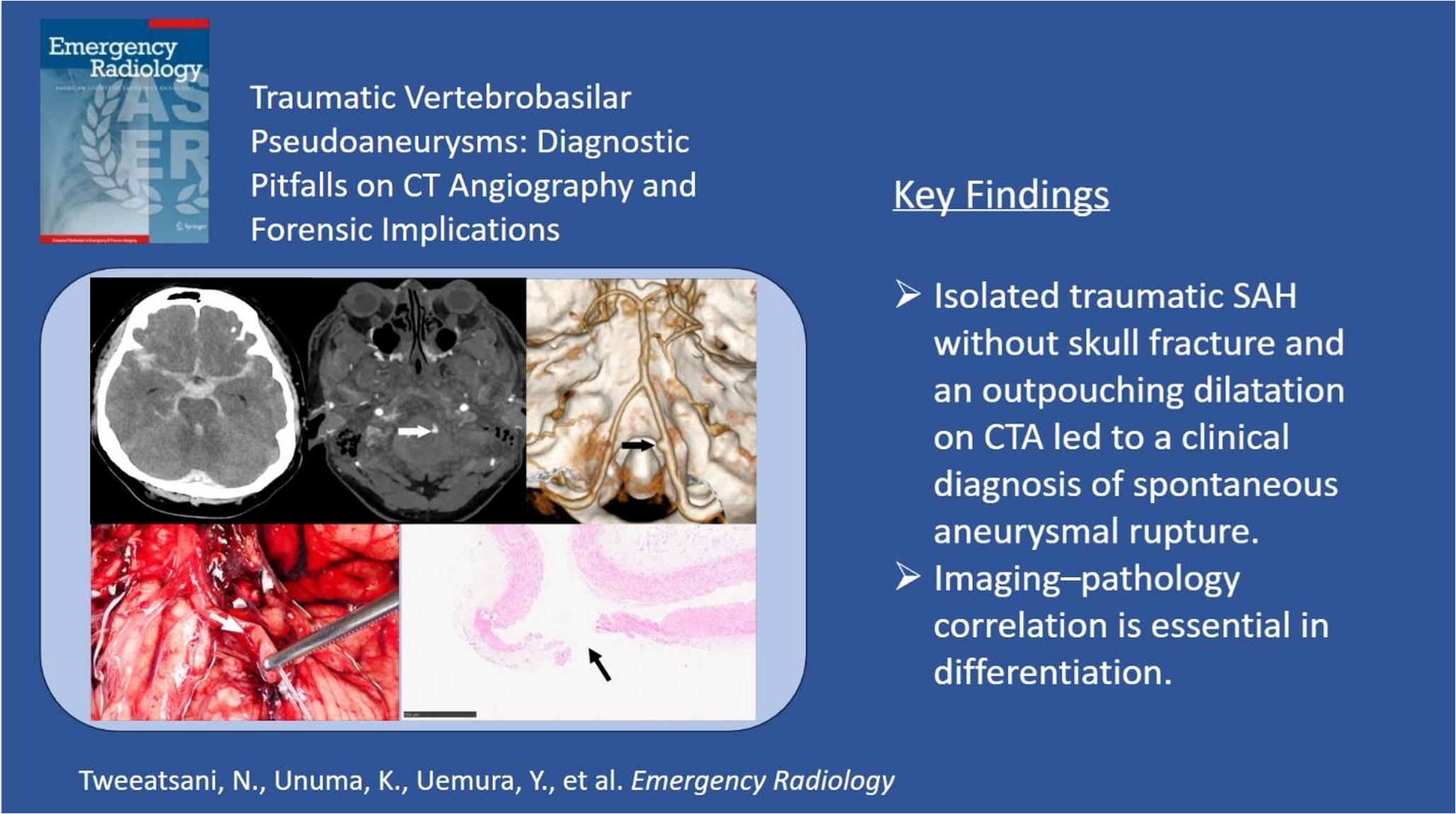Traumatic vertebrobasilar pseudoaneurysms: diagnostic pitfalls on CT angiography with forensic implications — two case reports