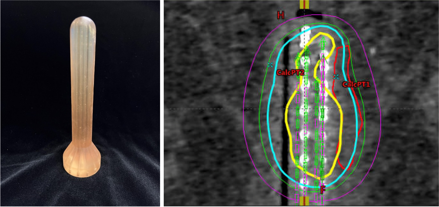 Emerging Role of Brachytherapy in the Non-operative Management of Rectal Cancer