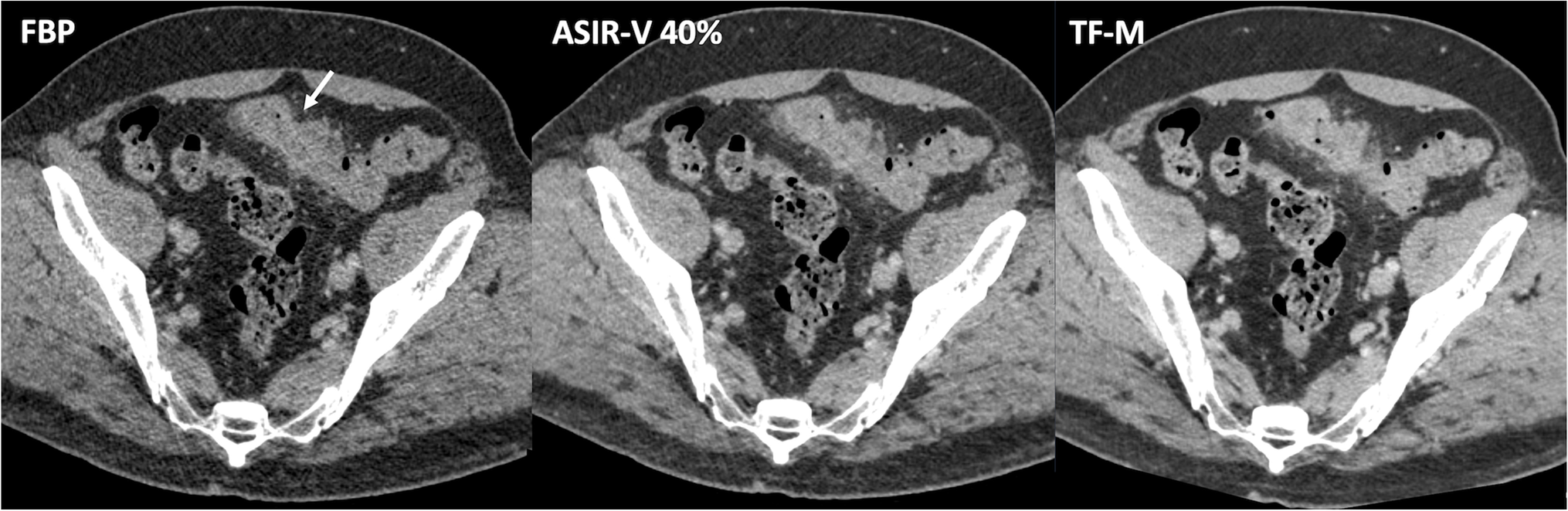 Imaging Advances on CT and MRI in Colorectal Cancer
