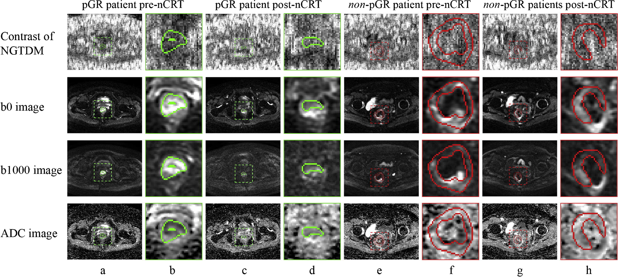 Recent Advances in Functional MRI to Predict Treatment Response for Locally Advanced Rectal Cancer