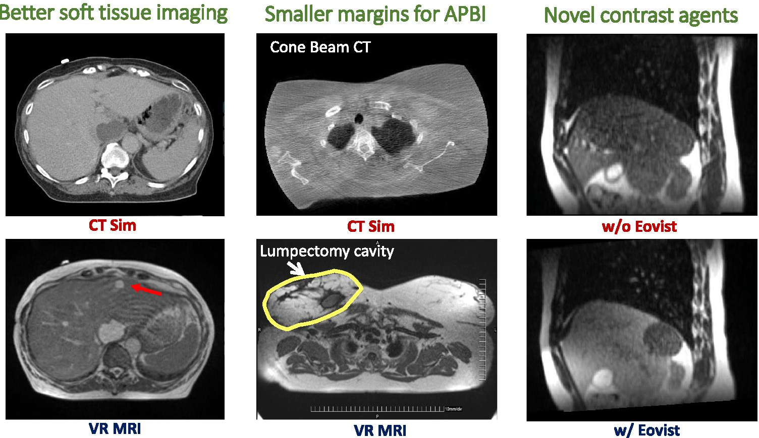 Role of MR-guided Radiotherapy (MRgRT) in Colorectal Cancer