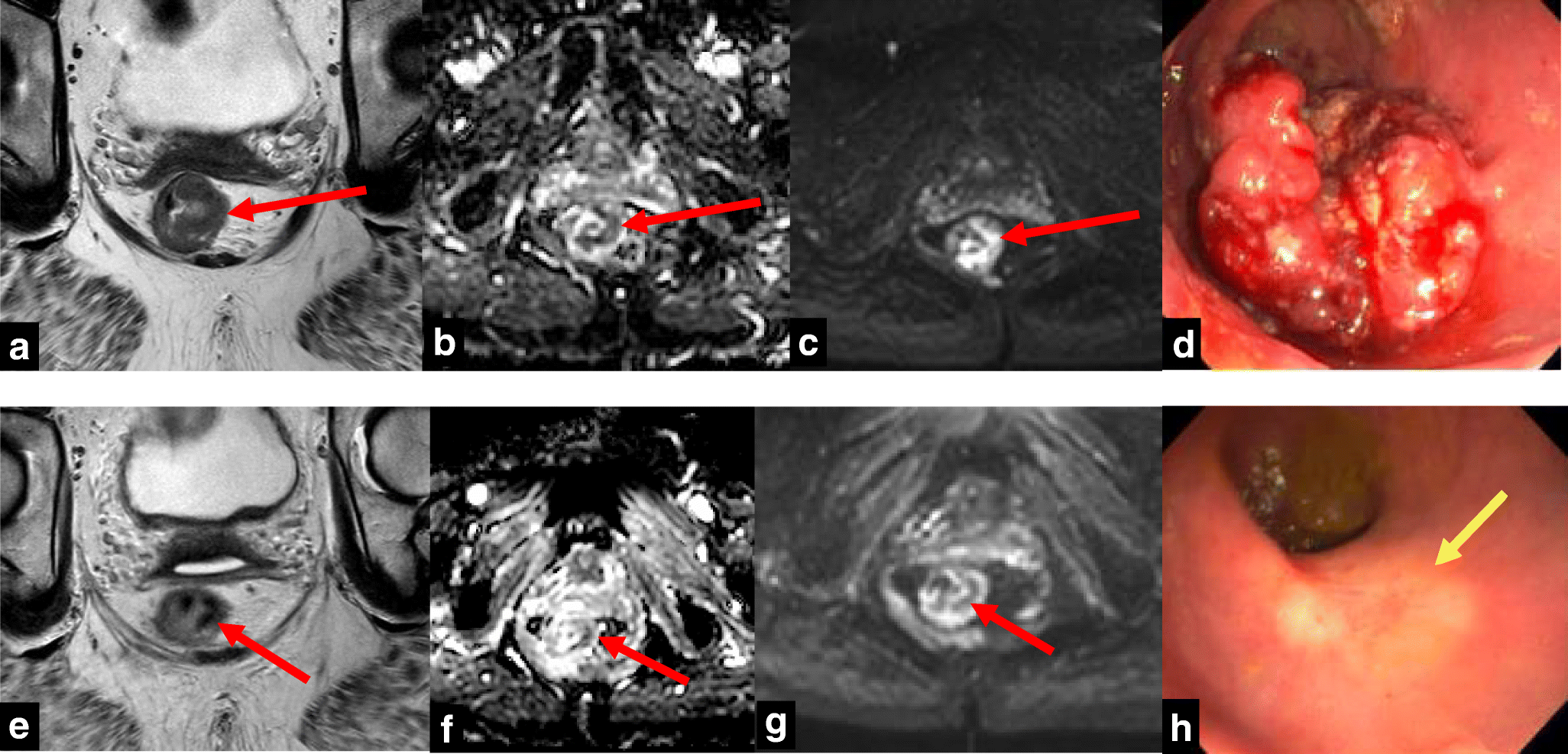 Non-operative Management (NOM) of Rectal Cancer: Literature Review and Translation of Evidence into Practice