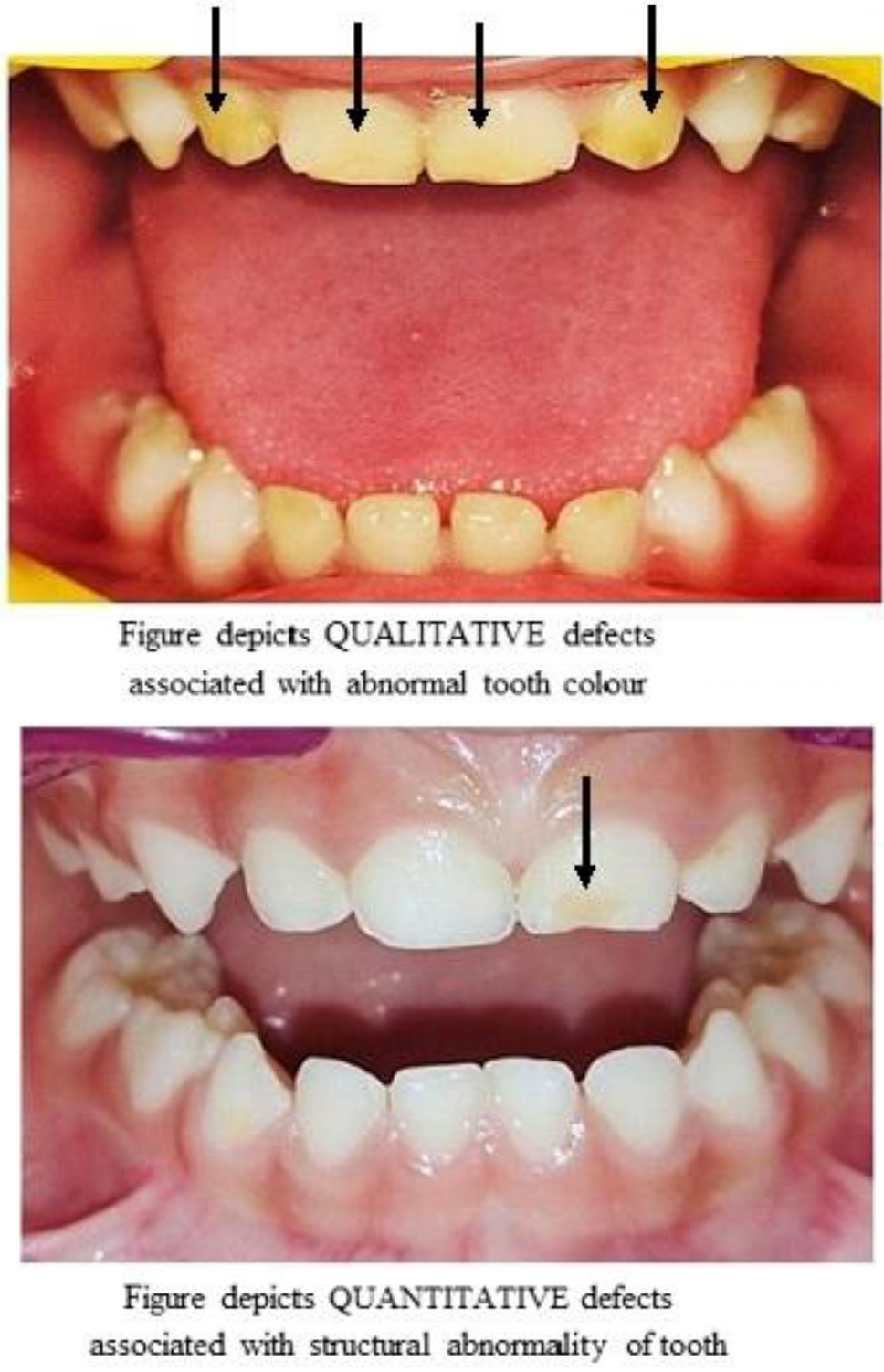 Impact of perinatal risk factors on developmental defect of enamel and dental caries in primary teeth of high-risk infants: a cross-sectional study