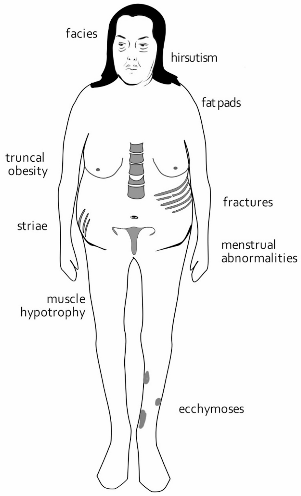 Who and how to screen for Cushing’s syndrome: the position statement of the Italian Society of Endocrinology