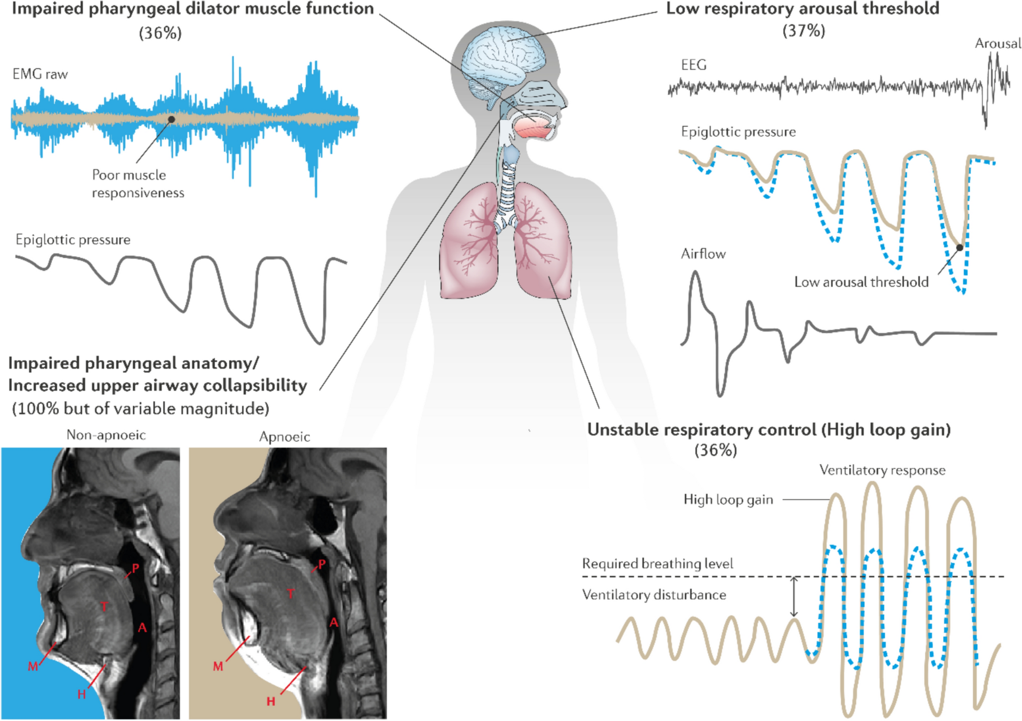 Developments in Pharmacotherapy for Obstructive Sleep Apnoea: Unlocking the Potential for Targeted Treatment