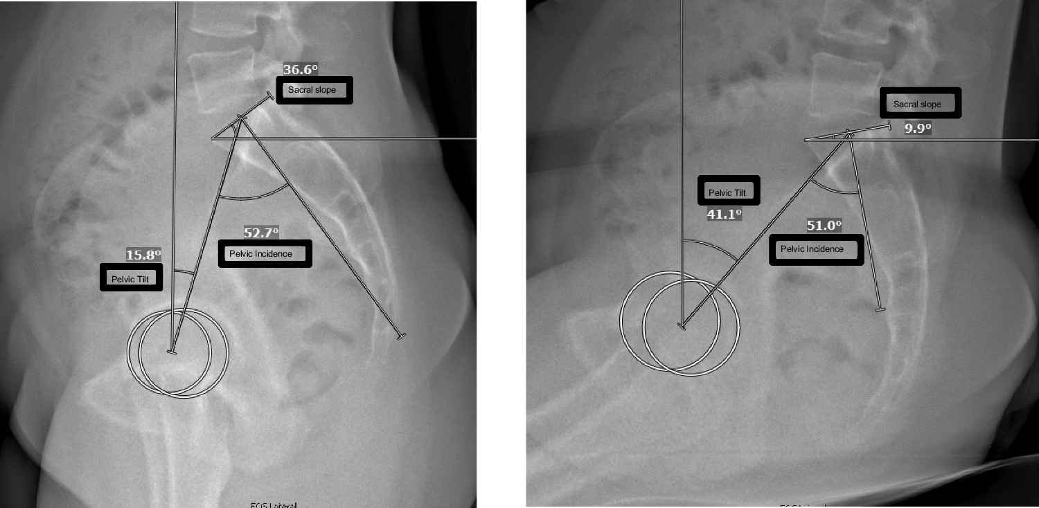 The Relationship Between the Lumbopelvic Spine and Hip in Femoroacetabular Impingement Patients