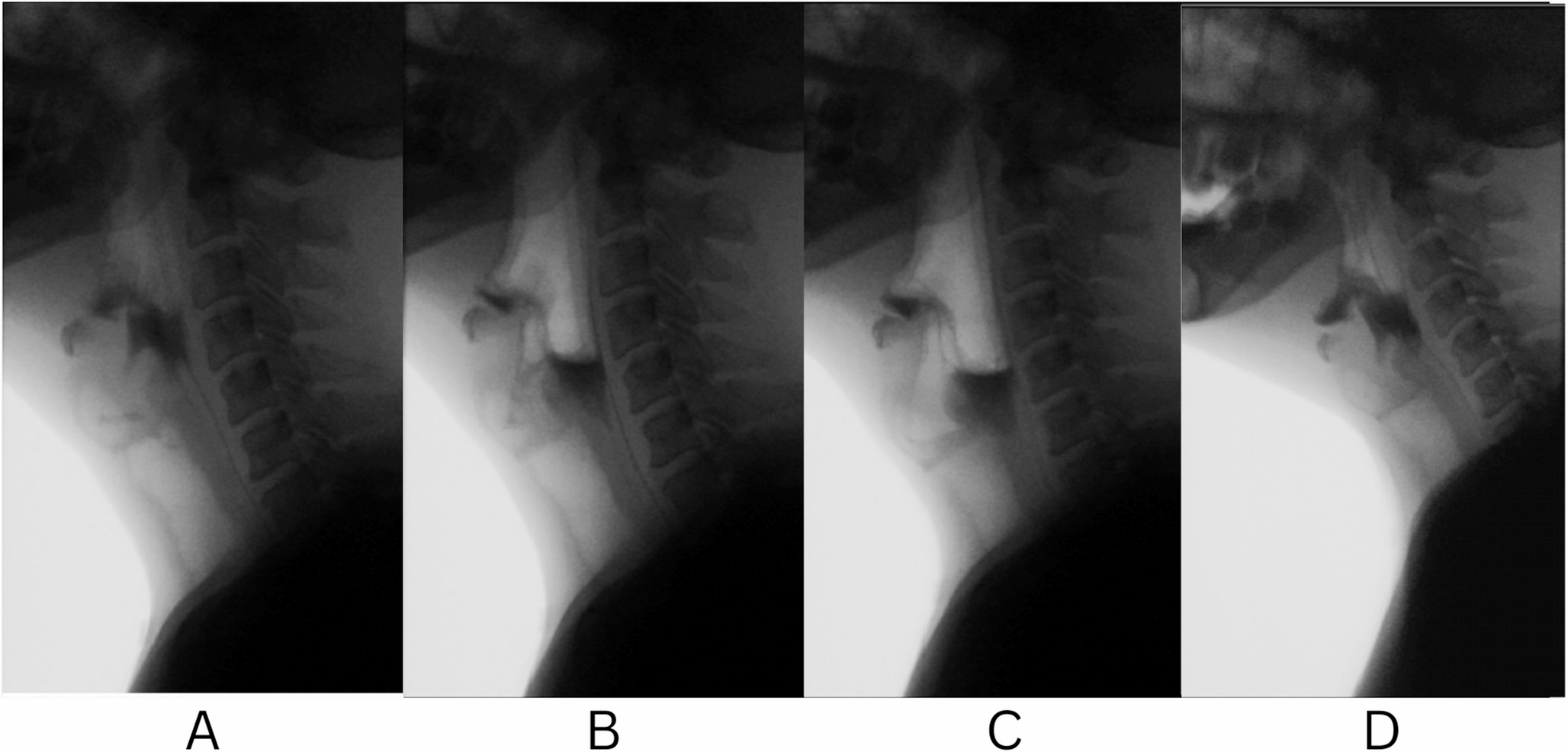 Clinical Conundrum: The Post-tonsillectomy Patient Who Refused to Swallow