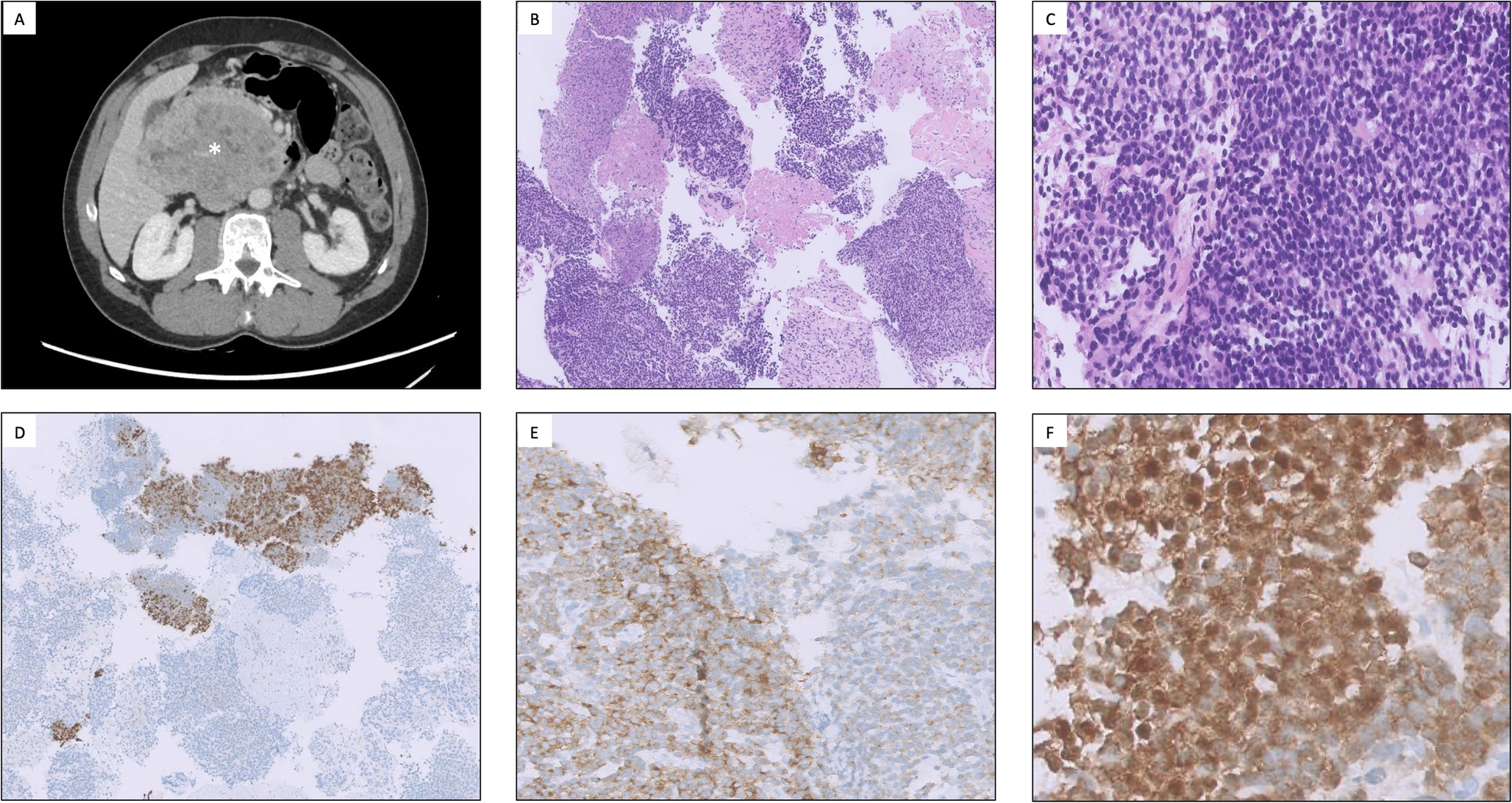 Adult Pancreatoblastoma: A Challenge in the Differential Diagnosis of Pancreatic Neuroendocrine Neoplasms