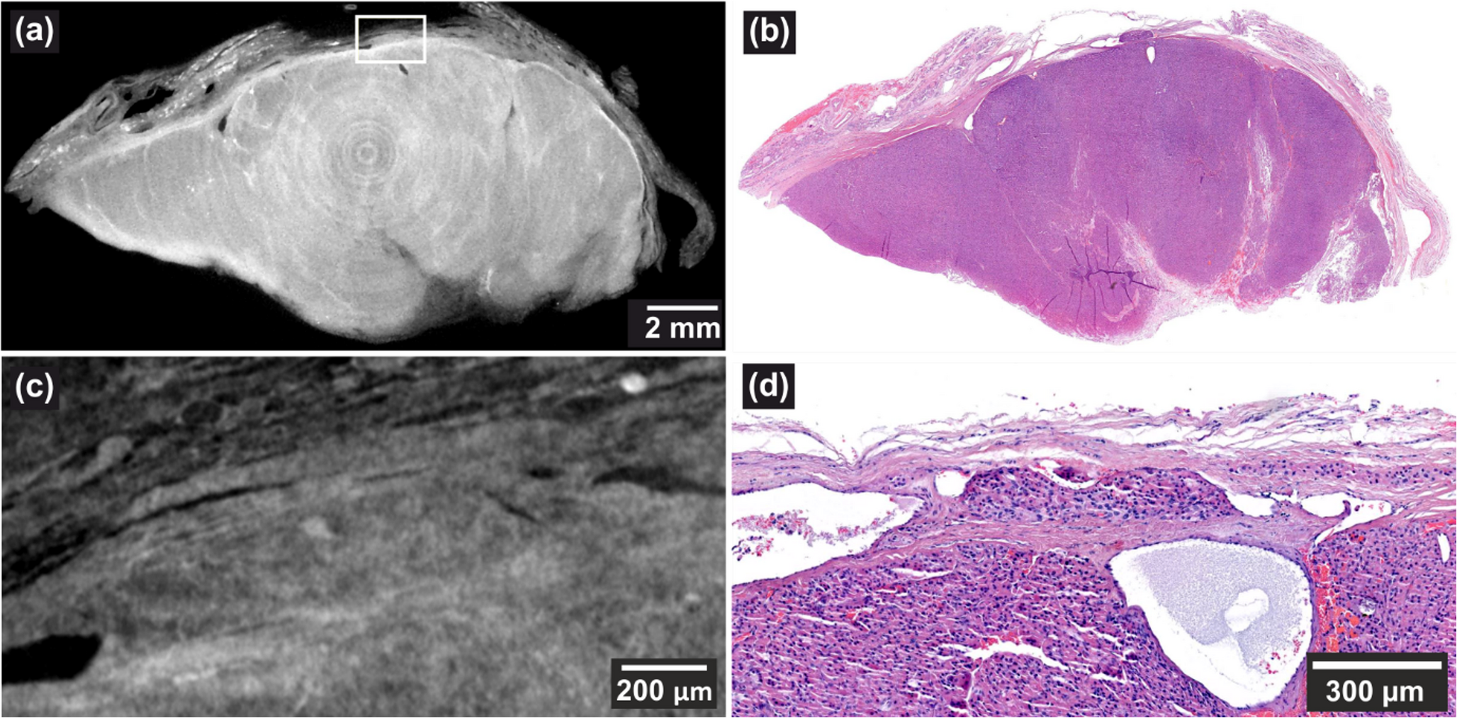 Follicular Thyroid Carcinoma Relapse Cases - Revisited by X-ray 3D Virtual Histology