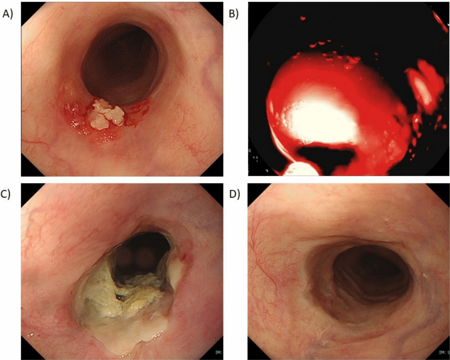 Long-term outcome of PDT for local failure after CRT or RT for oesophageal cancer