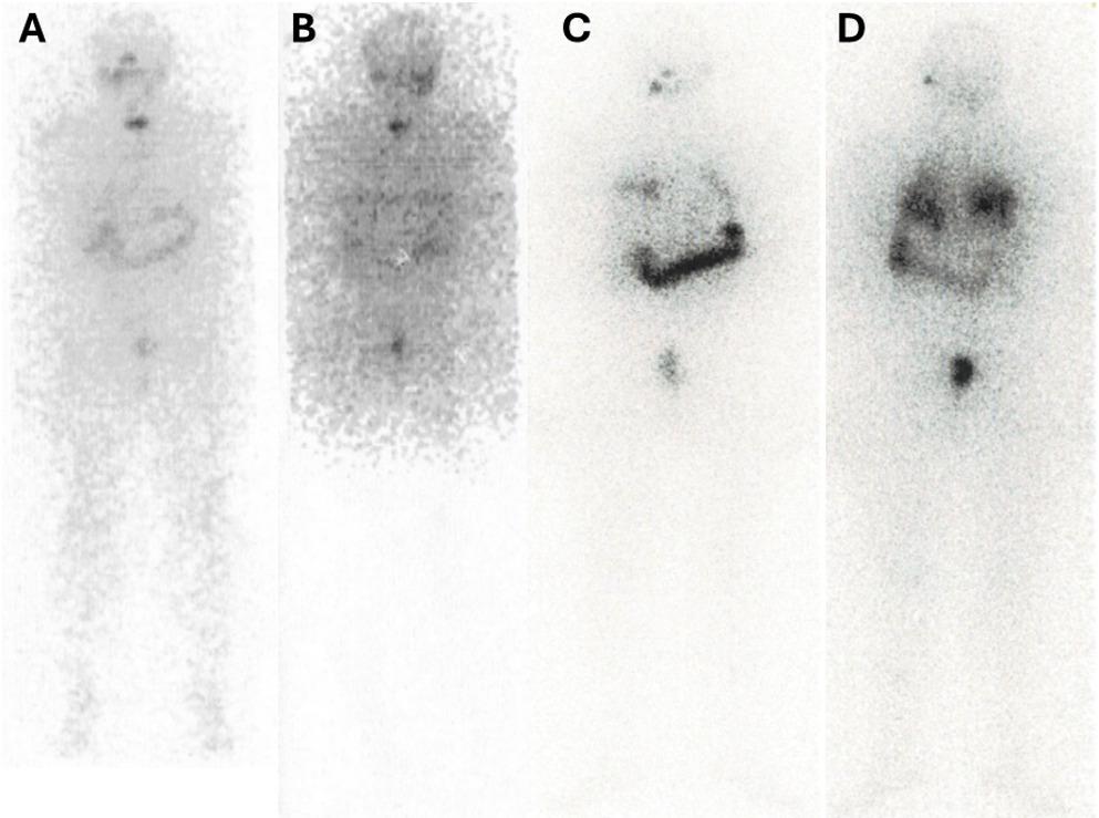 Short-Term BRAF Inhibition with Dabrafenib induced redifferentiation in a subset of patients with –Mutant papillary thyroid carcinoma