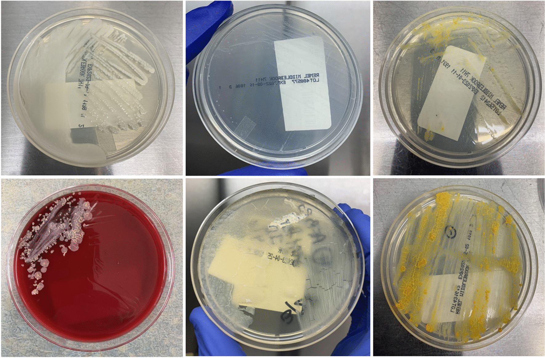 Non-Tuberculous Mycobacteria in Lung Transplant Recipients – A Review