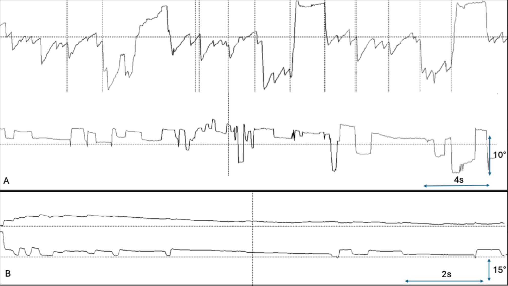 Effect of Aminopyridines on Oculomotor Dysfunction in Anti-GAD Ataxia: A Brief Report