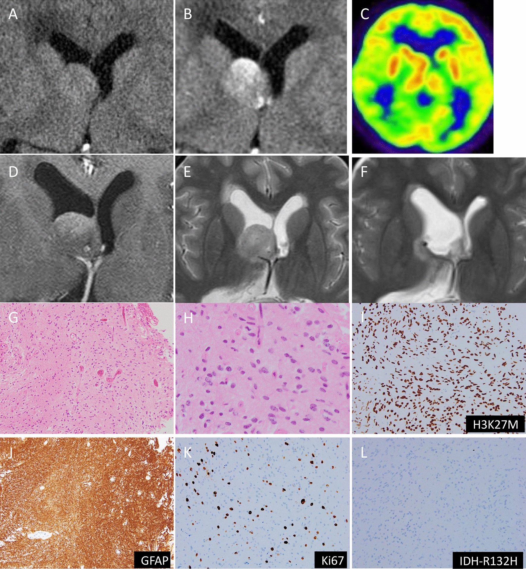 Histologically indolent but widely disseminated diffuse midline glioma H3K27-altered revealed by autopsy