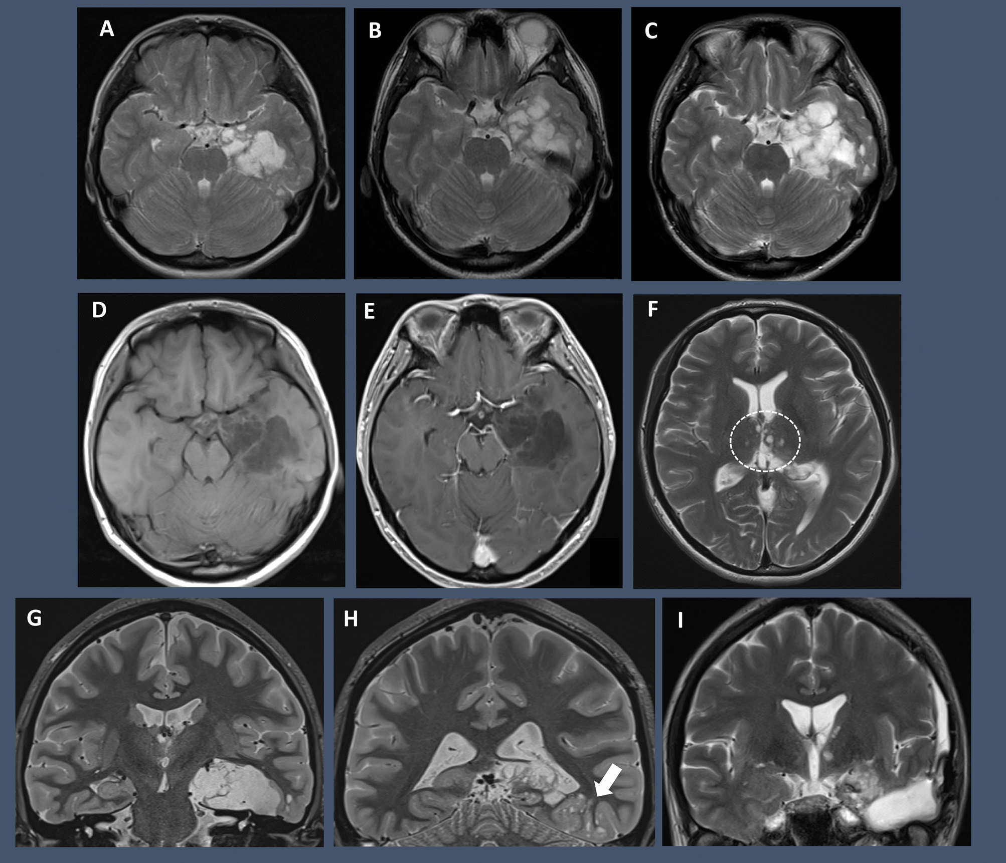 Multifocal rosette-forming glioneuronal tumor-like low-grade glioneuronal tumor with dysembryoplastic neuroepithelial tumor features associated with drug-resistant epilepsy: a case report and literature review