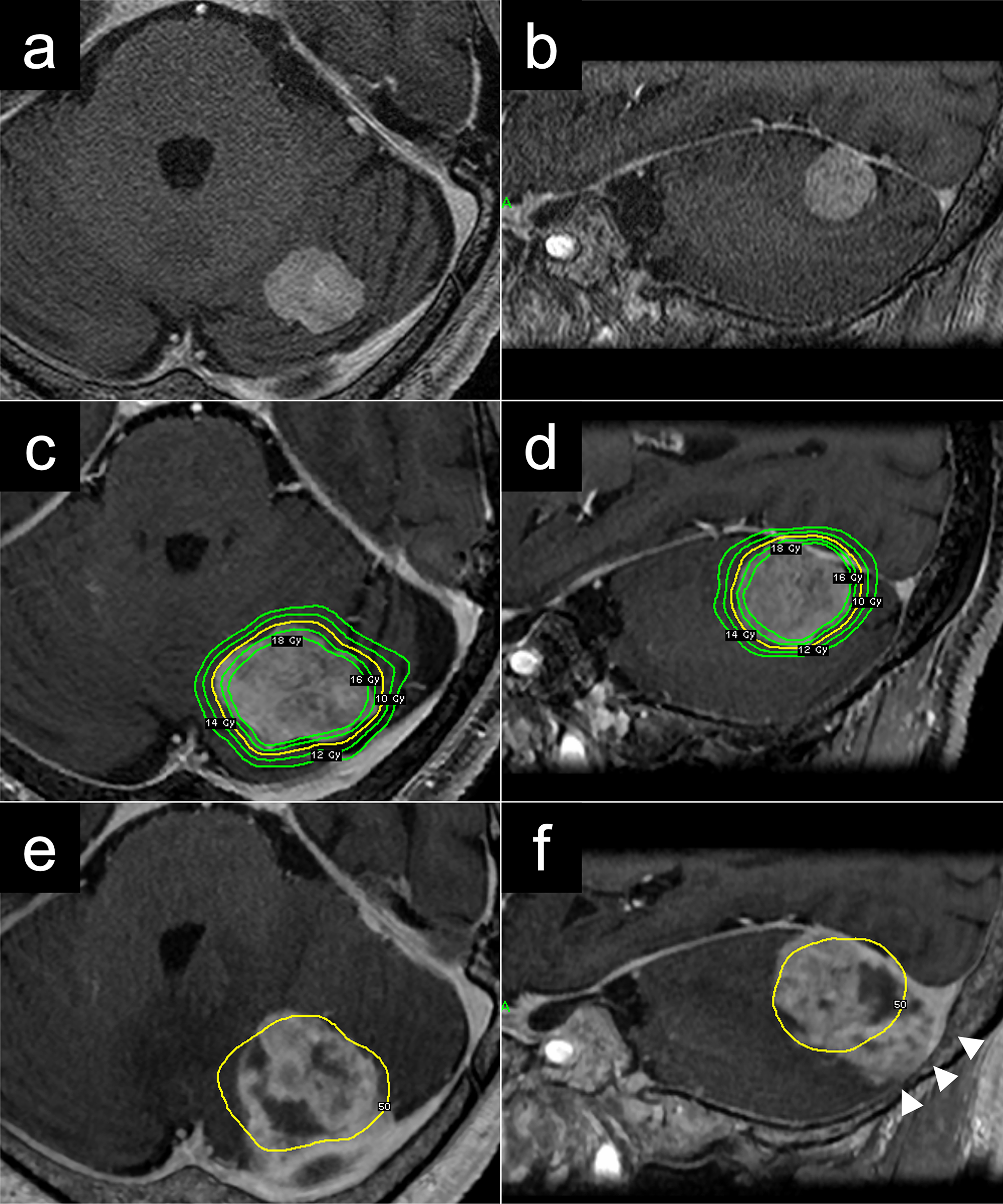 Comparative molecular profiles of distinct tumor components in recurrent tentorial meningioma after stereotactic radiosurgery: a case report implicating acquired aggressive alterations associated with WHO grade progression